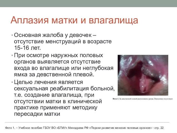 Аплазия матки и влагалища Основная жалоба у девочек – отсутствие менструаций в