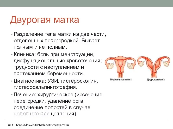 Двурогая матка Разделение тела матки на две части, отделенных перегородкой. Бывает полным