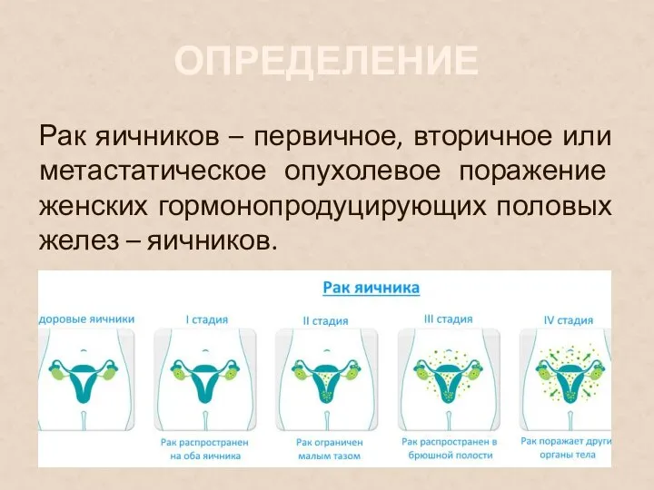 ОПРЕДЕЛЕНИЕ Рак яичников – первичное, вторичное или метастатическое опухолевое поражение женских гормонопродуцирующих половых желез – яичников.