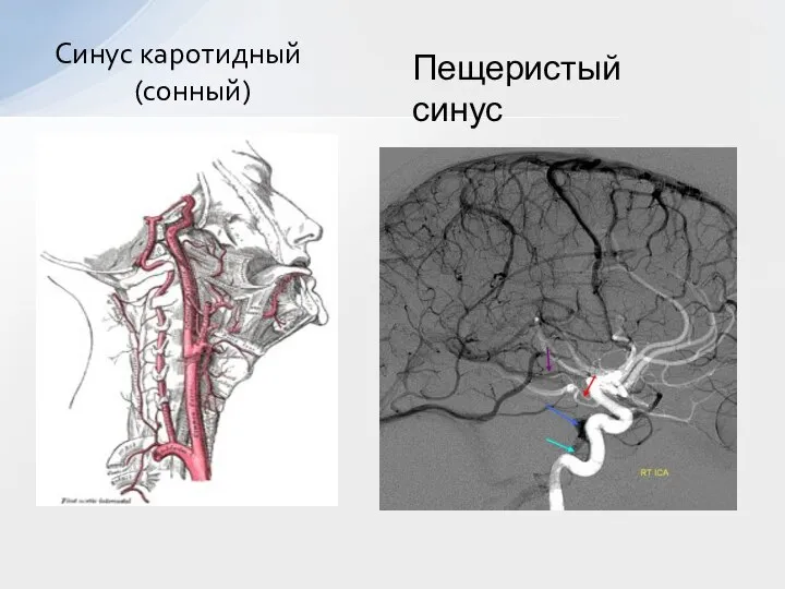 Синус каротидный (сонный) Пещеристый синус