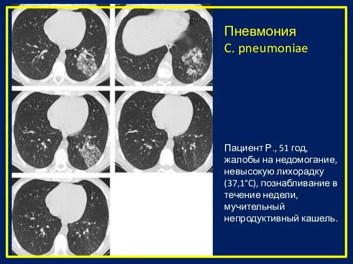 Пациент Р., 51 год, жалобы на недомогание, невысокую лихорадку (37,1°C), познабливание в