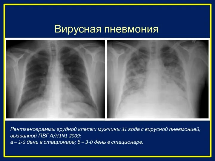 Вирусная пневмония Рентгенограммы грудной клетки мужчины 31 года с вирусной пневмонией, вызванной