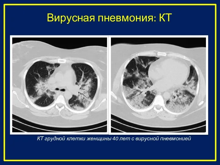 Вирусная пневмония: КТ КТ грудной клетки женщины 40 лет с вирусной пневмонией