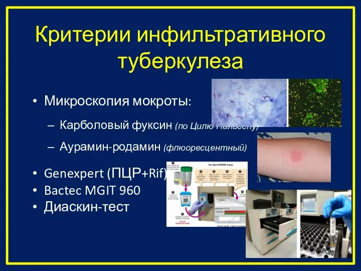 Критерии инфильтративного туберкулеза Микроскопия мокроты: Карболовый фуксин (по Цилю-Нильсену) Аурамин-родамин (флюоресцентный) Genexpert
