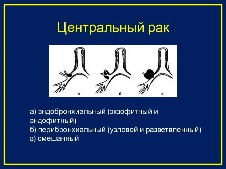 Центральный рак а) эндобронхиальный (экзофитный и эндофитный) б) перибронхиальный (узловой и разветвленный) в) смешанный