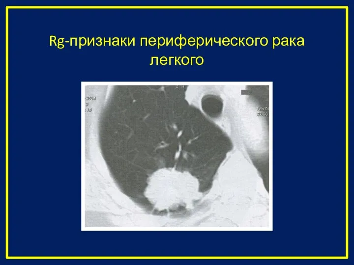 Rg-признаки периферического рака легкого