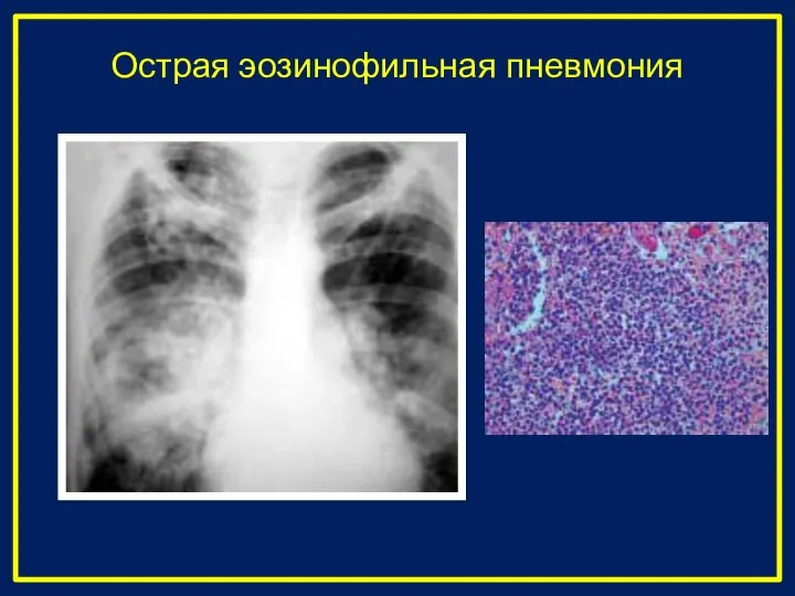 Острая эозинофильная пневмония