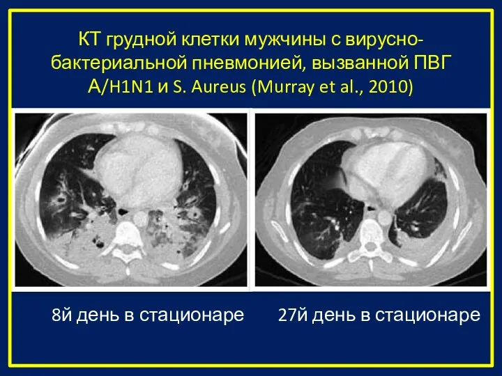 КТ грудной клетки мужчины с вирусно-бактериальной пневмонией, вызванной ПВГ А/H1N1 и S.
