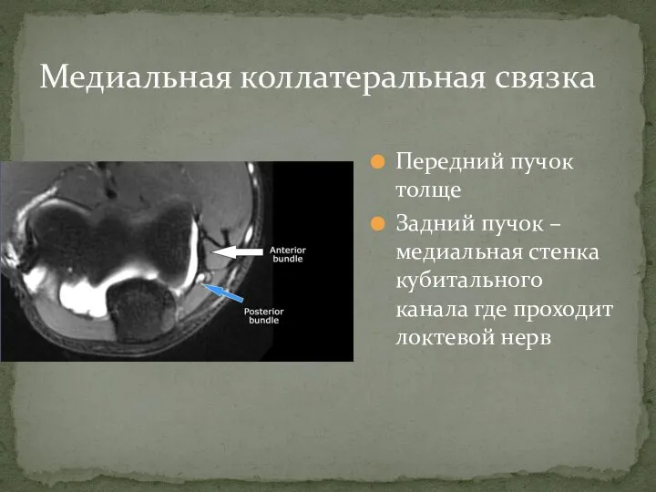 Передний пучок толще Задний пучок – медиальная стенка кубитального канала где проходит