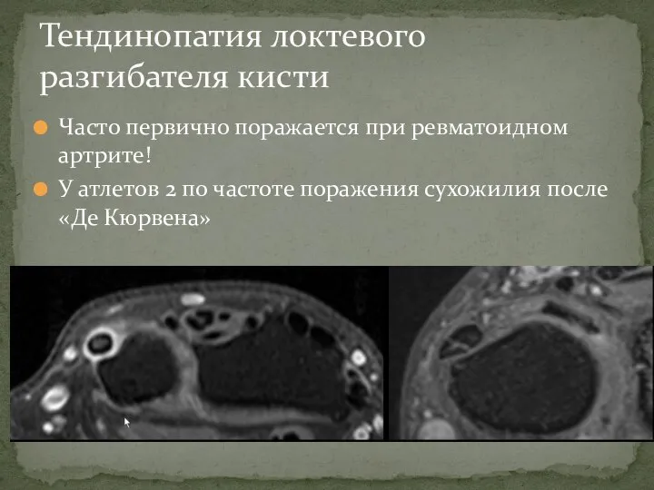 Часто первично поражается при ревматоидном артрите! У атлетов 2 по частоте поражения