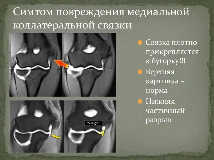 Связка плотно прикрепляется к бугорку!!! Верхняя картинка – норма Нижняя – частичный