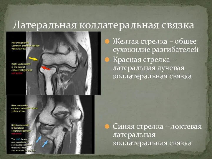 Желтая стрелка – общее сухожилие разгибателей Красная стрелка – латеральная лучевая коллатеральная