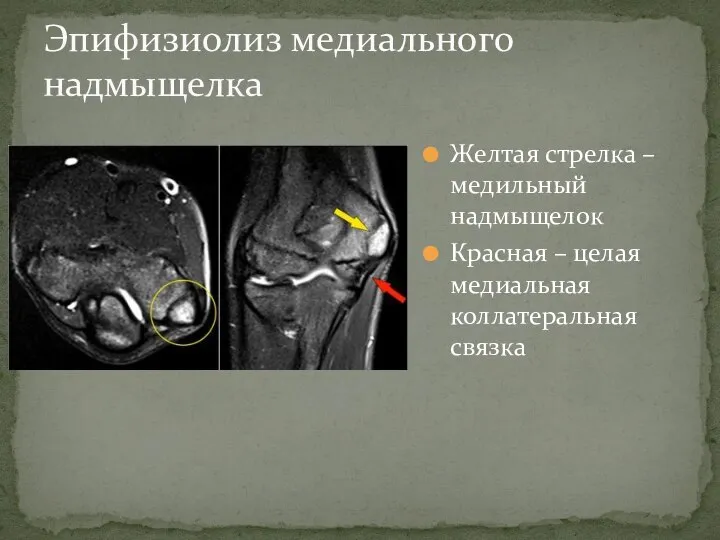 Желтая стрелка – медильный надмыщелок Красная – целая медиальная коллатеральная связка Эпифизиолиз медиального надмыщелка