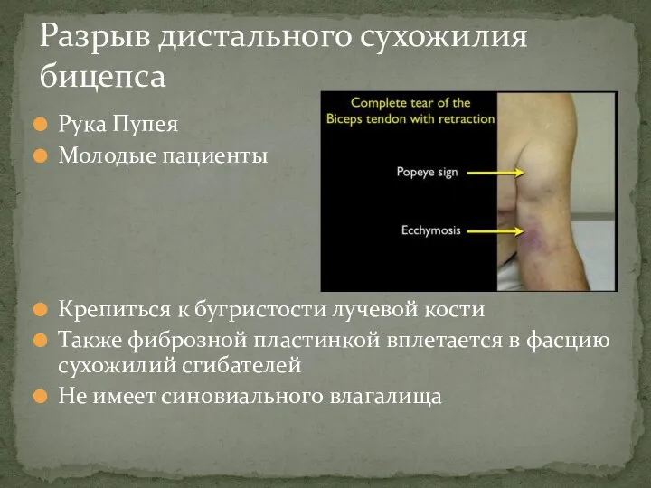 Рука Пупея Молодые пациенты Крепиться к бугристости лучевой кости Также фиброзной пластинкой