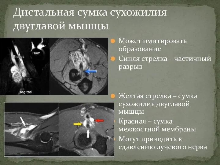 Может имитировать образование Синяя стрелка – частичный разрыв Желтая стрелка – сумка