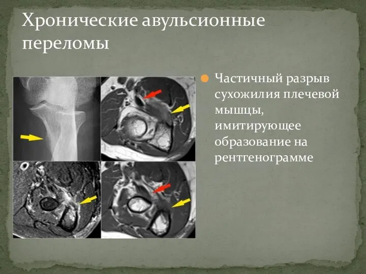 Частичный разрыв сухожилия плечевой мышцы, имитирующее образование на рентгенограмме Хронические авульсионные переломы