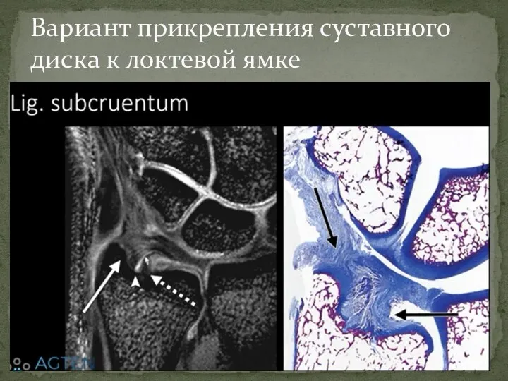 Вариант прикрепления суставного диска к локтевой ямке