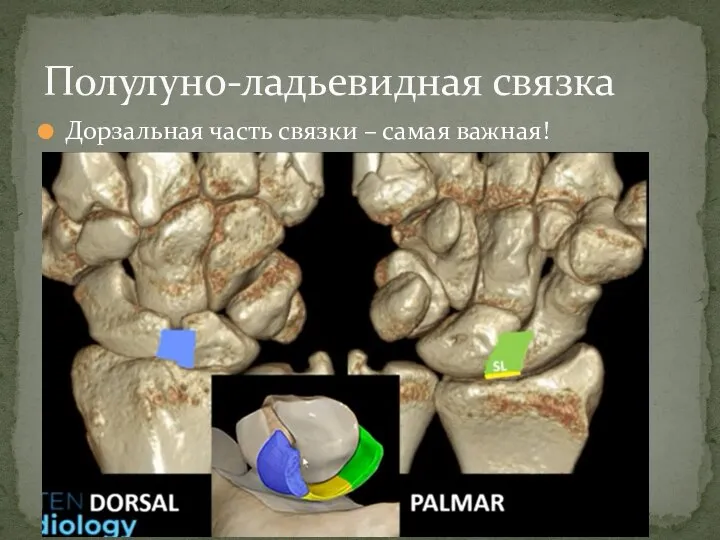 Дорзальная часть связки – самая важная! Полулуно-ладьевидная связка