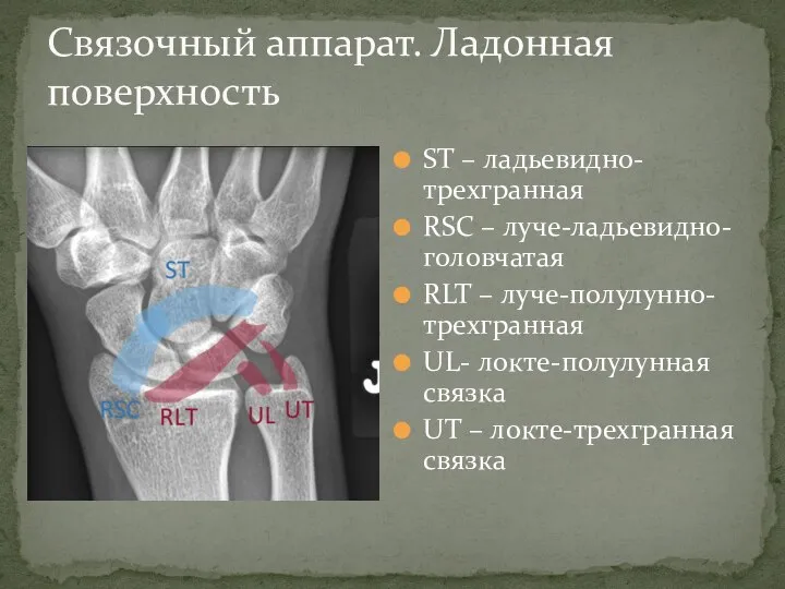 ST – ладьевидно-трехгранная RSC – луче-ладьевидно-головчатая RLT – луче-полулунно-трехгранная UL- локте-полулунная связка