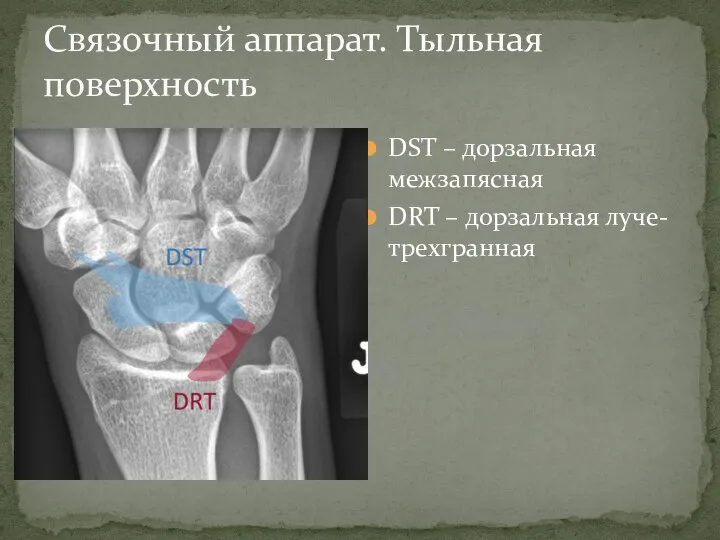 DST – дорзальная межзапясная DRT – дорзальная луче-трехгранная Связочный аппарат. Тыльная поверхность