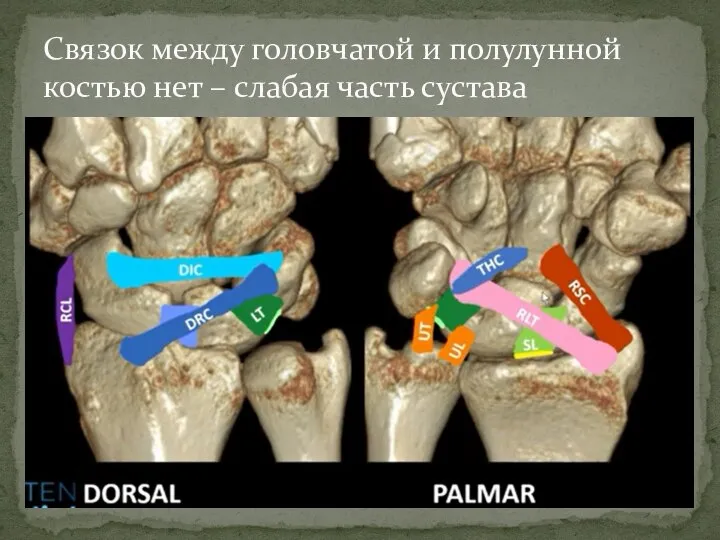 Связок между головчатой и полулунной костью нет – слабая часть сустава