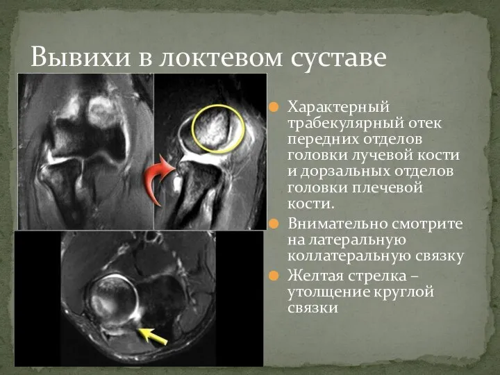 Характерный трабекулярный отек передних отделов головки лучевой кости и дорзальных отделов головки