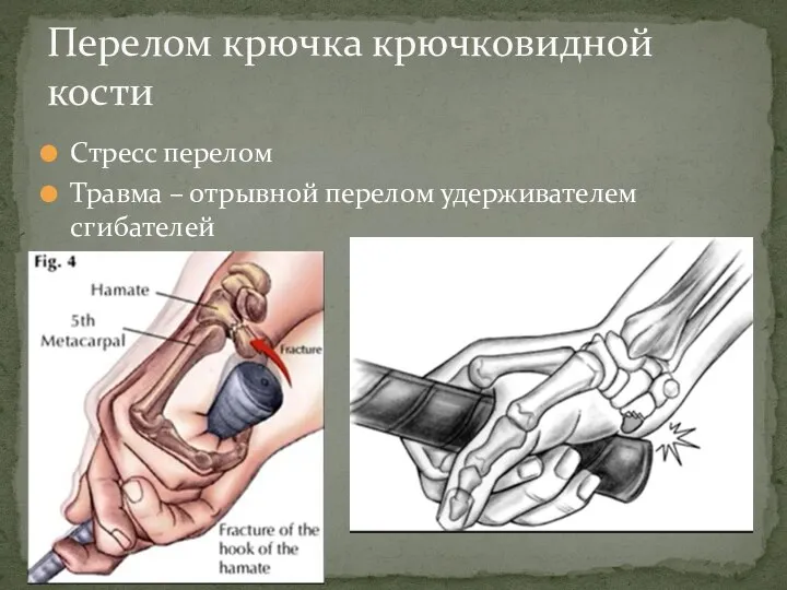 Стресс перелом Травма – отрывной перелом удерживателем сгибателей Перелом крючка крючковидной кости