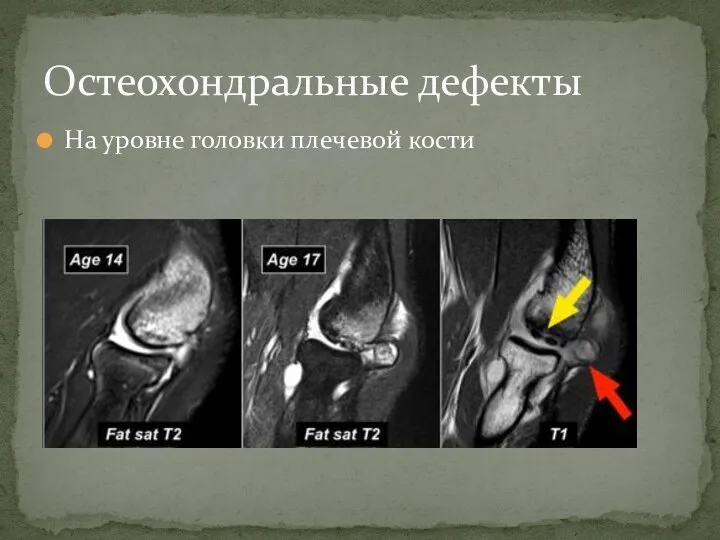 На уровне головки плечевой кости Остеохондральные дефекты