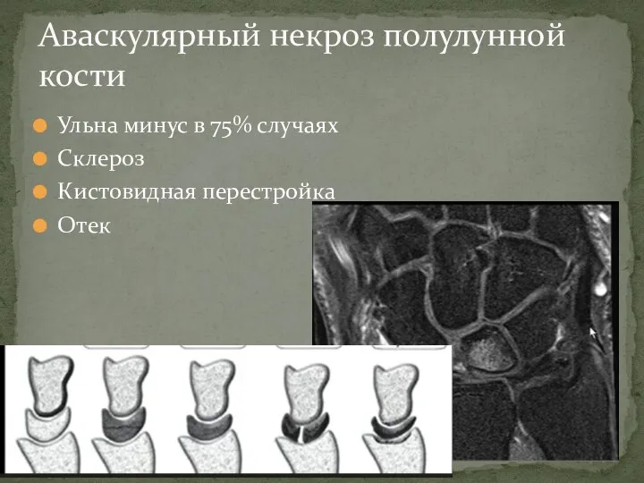 Ульна минус в 75% случаях Склероз Кистовидная перестройка Отек Аваскулярный некроз полулунной кости