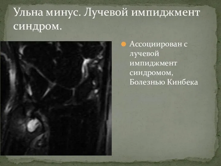 Ассоциирован с лучевой импиджмент синдромом, Болезнью Кинбека Ульна минус. Лучевой импиджмент синдром.