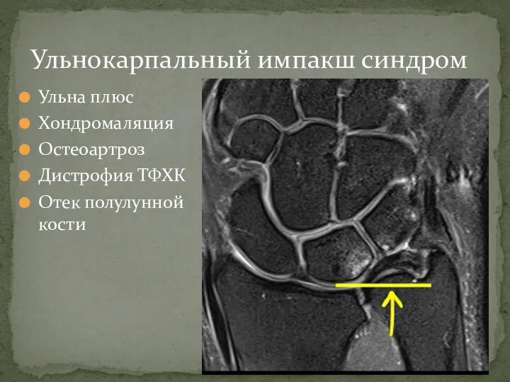 Ульна плюс Хондромаляция Остеоартроз Дистрофия ТФХК Отек полулунной кости Ульнокарпальный импакш синдром