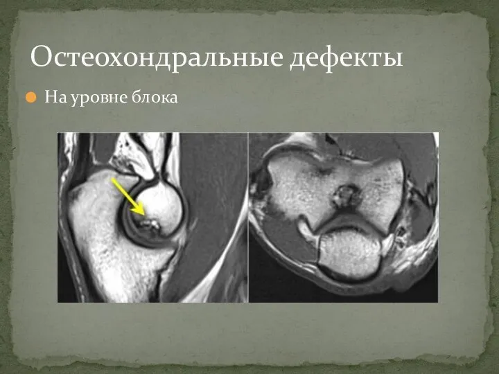 На уровне блока Остеохондральные дефекты