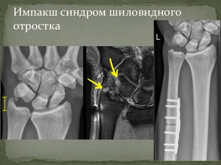 Импакш синдром шиловидного отростка