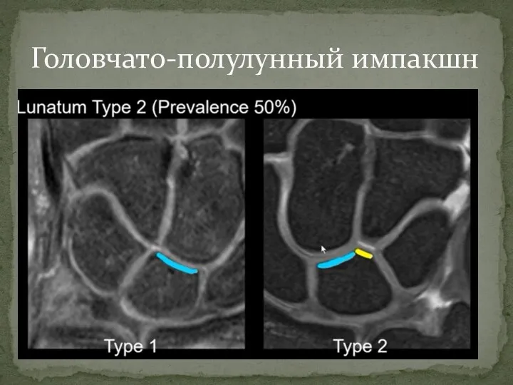 Головчато-полулунный импакшн