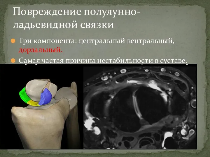 Три компонента: центральный вентральный, дорзальный. Самая частая причина нестабильности в суставе. Повреждение полулунно-ладьевидной связки