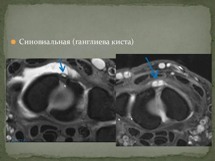 Синовиальная (ганглиева киста)