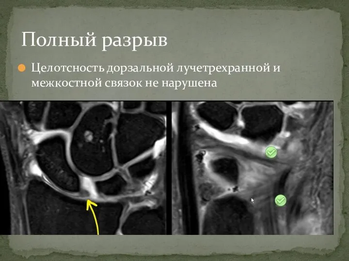 Целотсность дорзальной лучетрехранной и межкостной связок не нарушена Полный разрыв