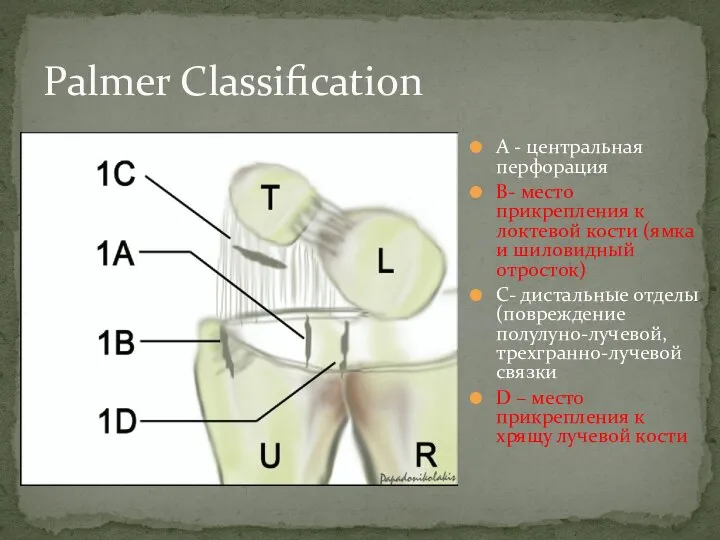 Palmer Classification А - центральная перфорация B- место прикрепления к локтевой кости