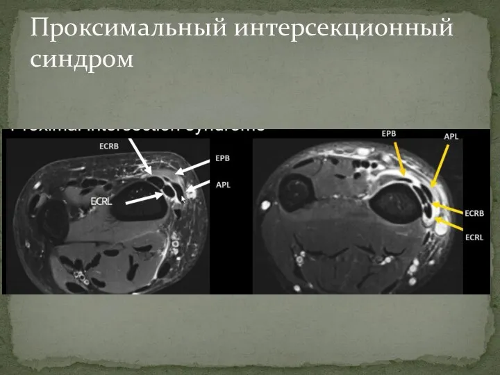 Проксимальный интерсекционный синдром