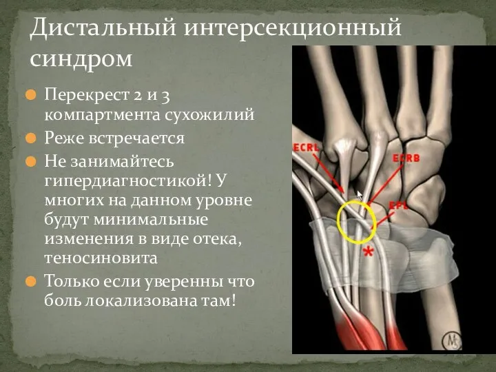 Перекрест 2 и 3 компартмента сухожилий Реже встречается Не занимайтесь гипердиагностикой! У