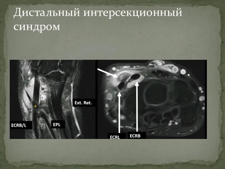 Дистальный интерсекционный синдром