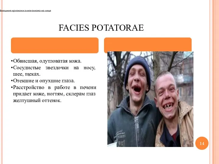 FACIES POTATORAE Обвисшая, одутловатая кожа. Сосудистые звездочки на носу, шее, щеках. Отекшие