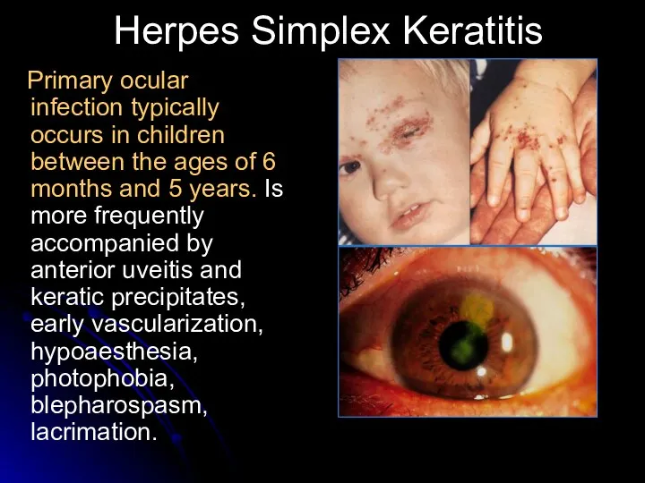 Herpes Simplex Keratitis Primary ocular infection typically occurs in children between the