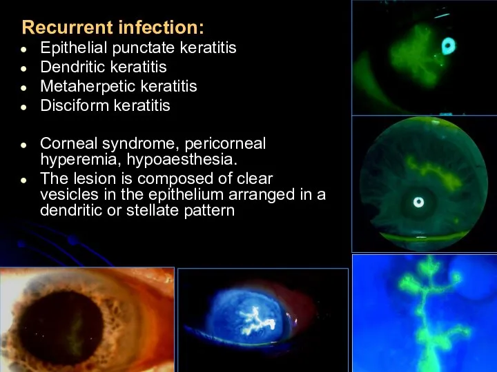 Recurrent infection: Epithelial punctate keratitis Dendritic keratitis Metaherpetic keratitis Disciform keratitis Corneal