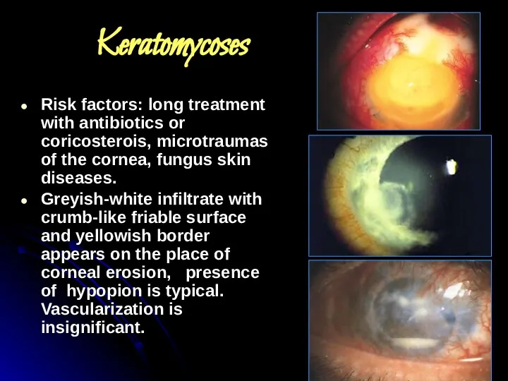 Keratomycoses Risk factors: long treatment with antibiotics or coricosterois, microtraumas of the