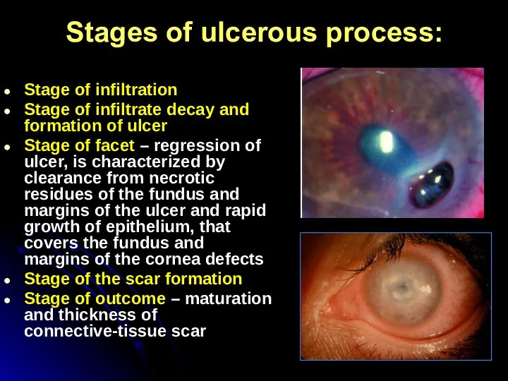 Stages of ulcerous process: Stage of infiltration Stage of infiltrate decay and