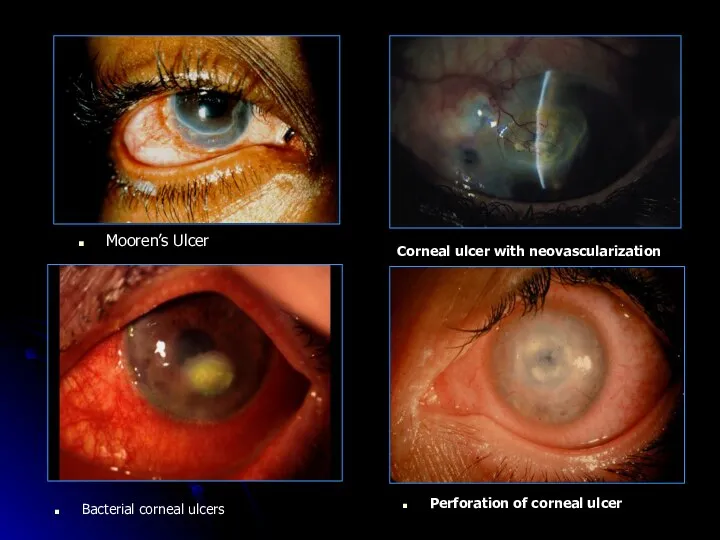Mooren’s Ulcer Corneal ulcer with neovascularization Bacterial corneal ulcers Perforation of corneal ulcer