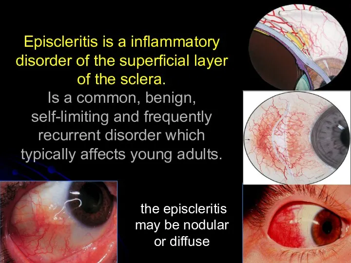 Episcleritis is a inflammatory disorder of the superficial layer of the sclera.
