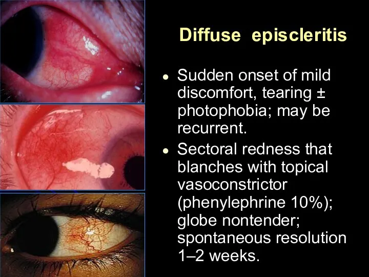 Diffuse episcleritis Sudden onset of mild discomfort, tearing ± photophobia; may be