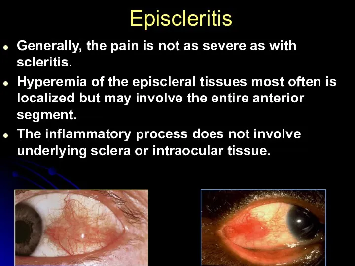 Episcleritis Generally, the pain is not as severe as with scleritis. Hyperemia